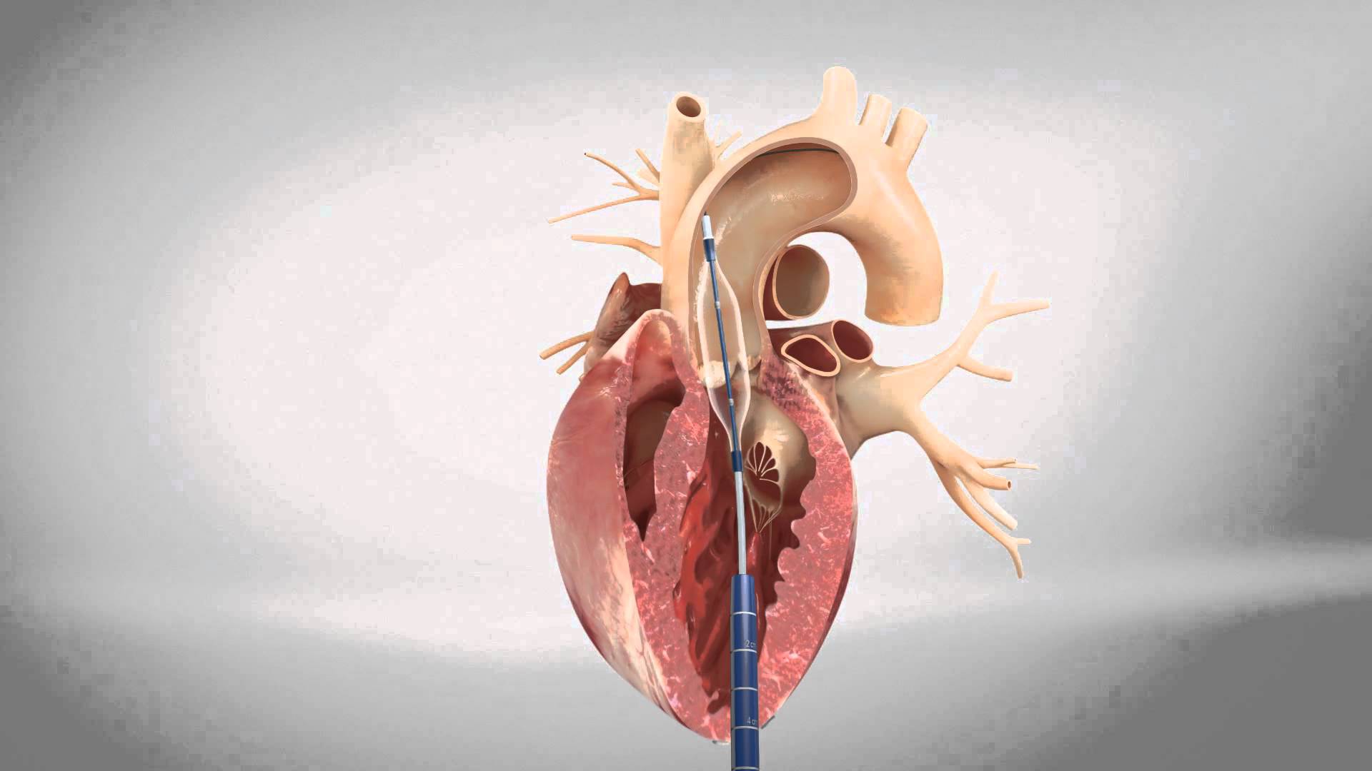 A Step-By-Step Guide to TAVR