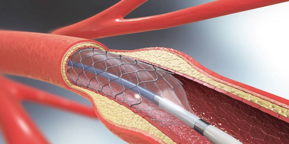 A Step-By-Step Guide to TAVR