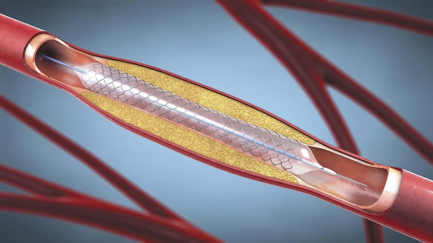 When Do You Really Need a Heart Stent? Indicators & Treatment Options