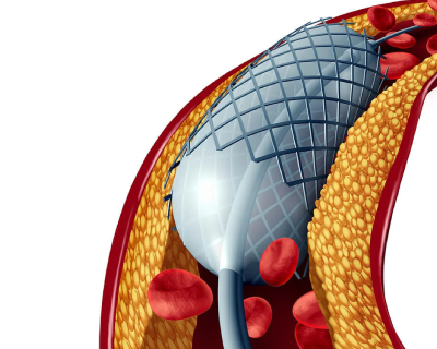 chronic-total-occlusions