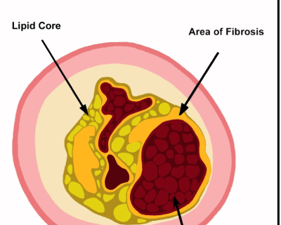 chronic-total-occlusions2