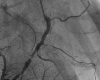 coronary-angiogram-first