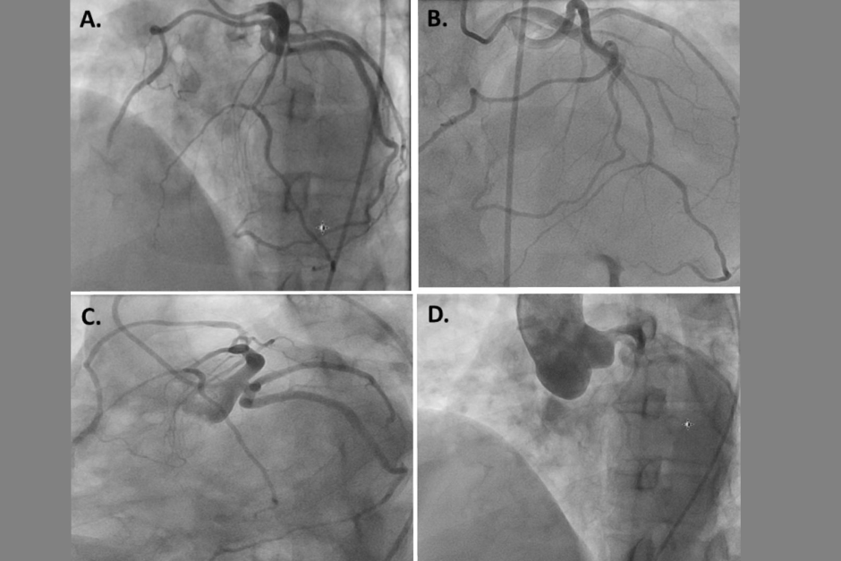 coronary-angiogram-testing-in-hyderabad