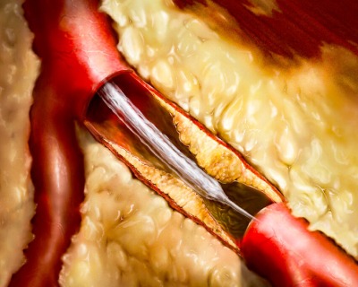 coronary-angioplasty-first