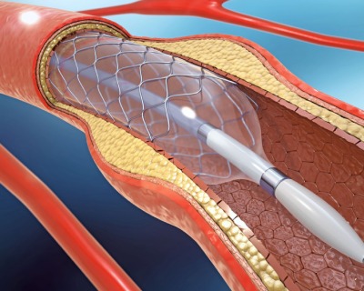coronary-angioplasty-first