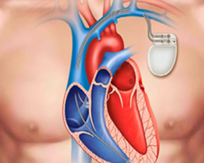 pacemakers