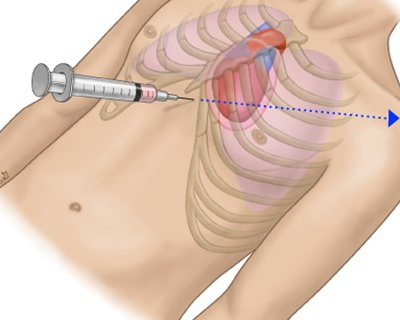 pericardiocentesis