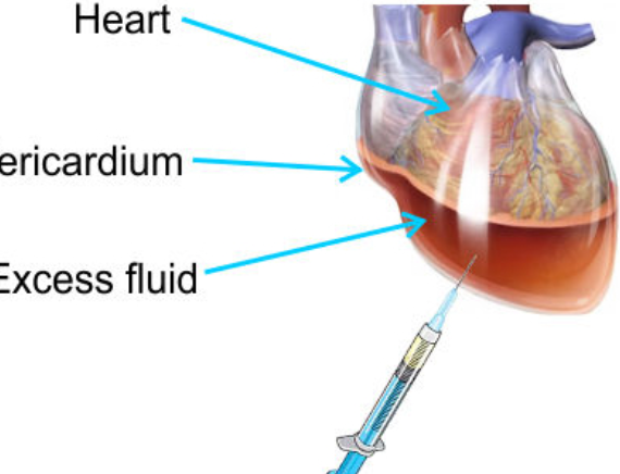 pericardiocentesis2