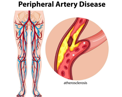 peripheral-angioplasty