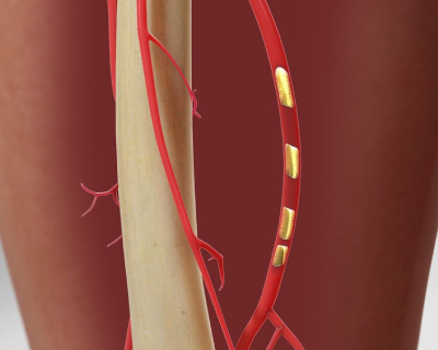 peripheral-angioplasty