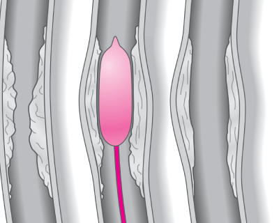 primary-coronary-angioplasty