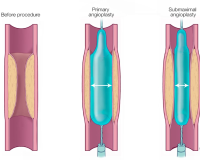 primary-coronary-angioplasty