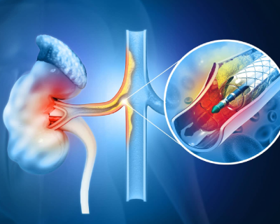 renal-angioplasty2