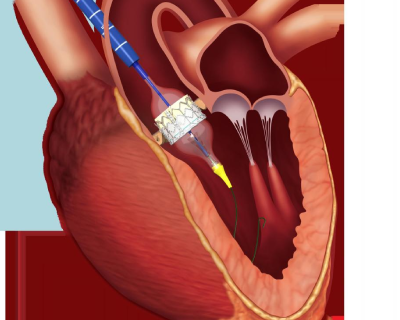 tavi-tavr2.png